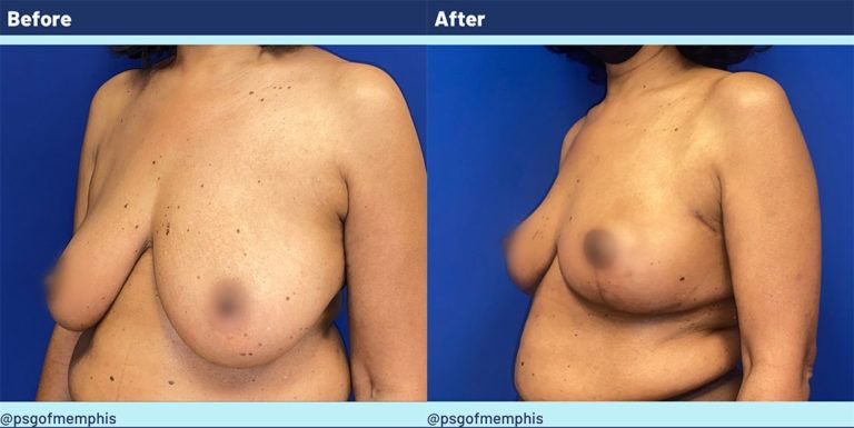 Breast Lift Before & After