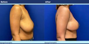 Breast Lift Before & After