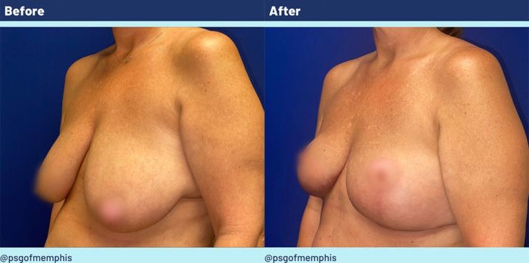Breast Lift Before & After