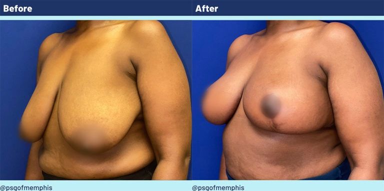 Breast Lift Before & After