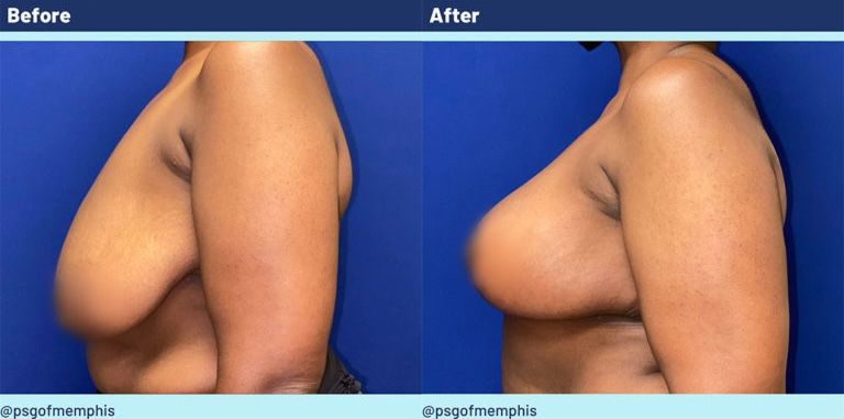 Breast Lift Before & After