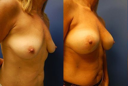 Breast Lift Before & After