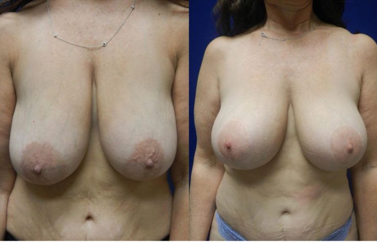 Breast Lift Before & After
