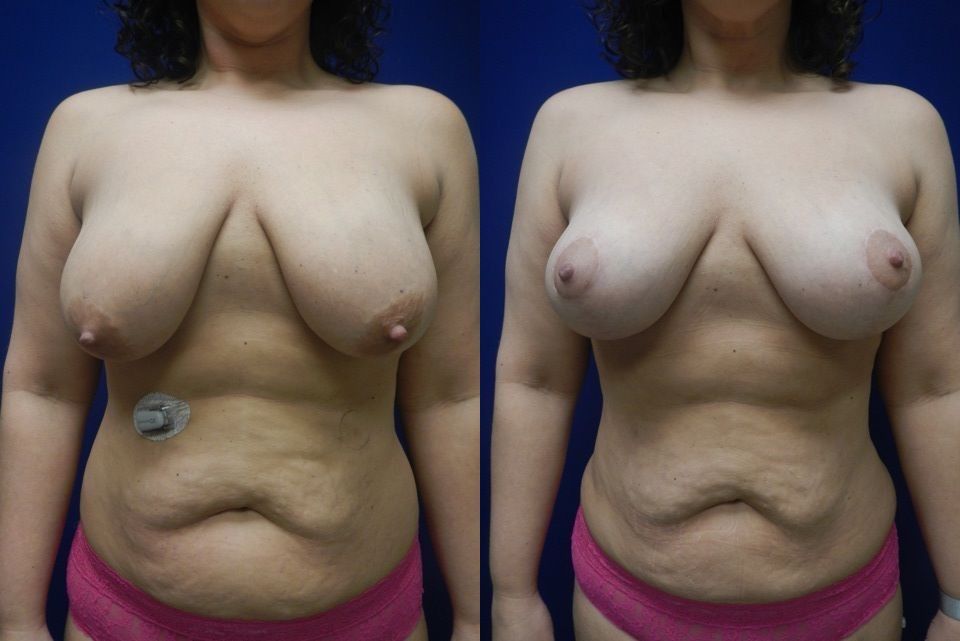 Breast Lift Before & After