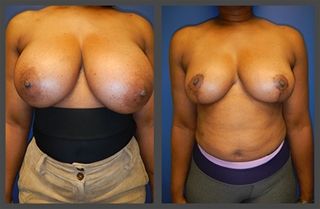 Breast Lift Before & After
