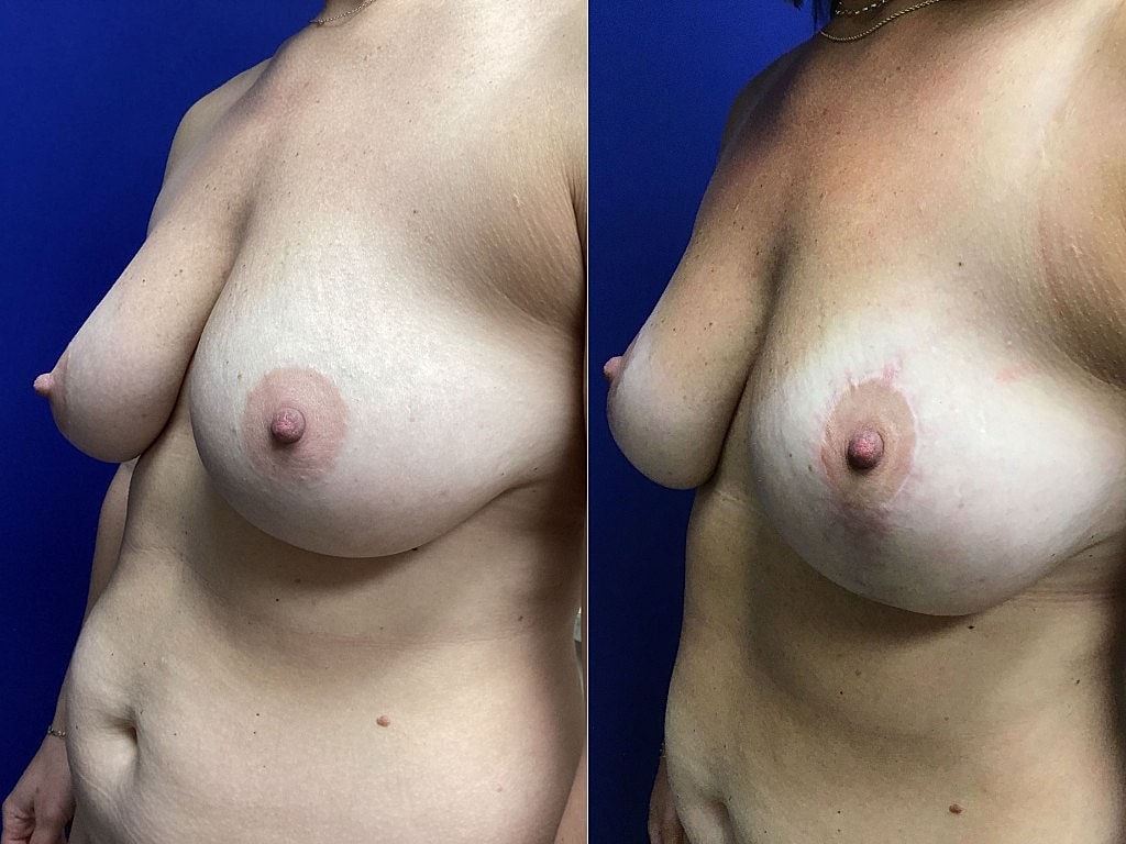 Breast Lift Before & After