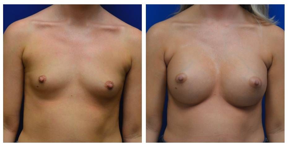 Breast Augmentation Before & After