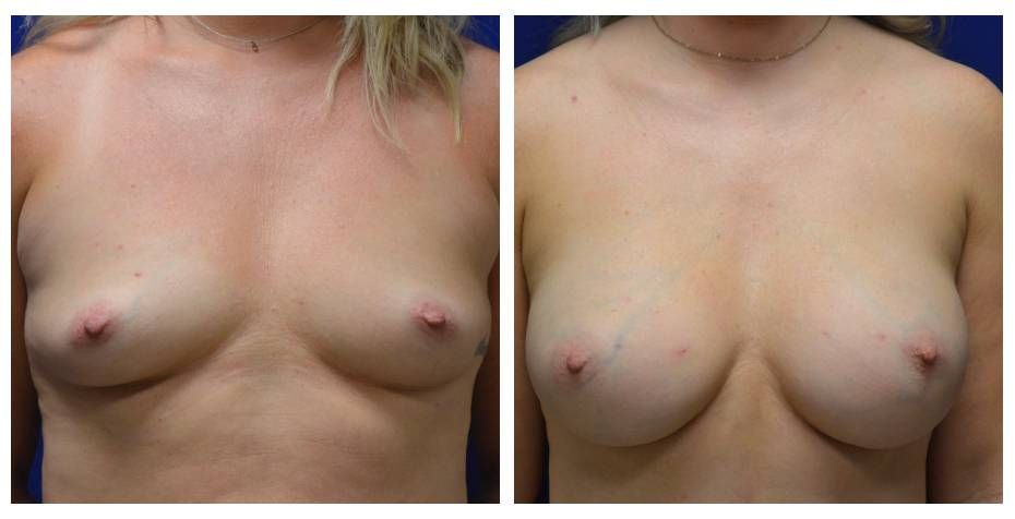 Breast Augmentation Before & After