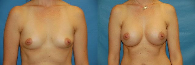 Breast Augmentation Before & After