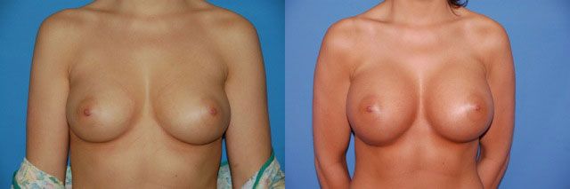 Breast Augmentation Before & After