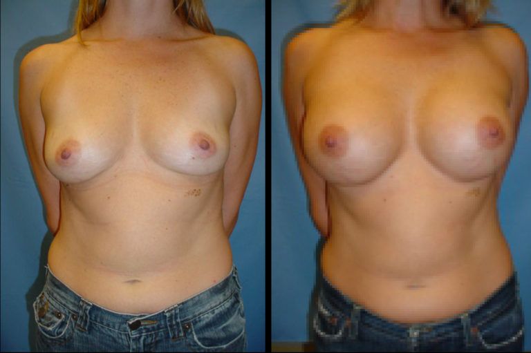 Breast Augmentation Before & After