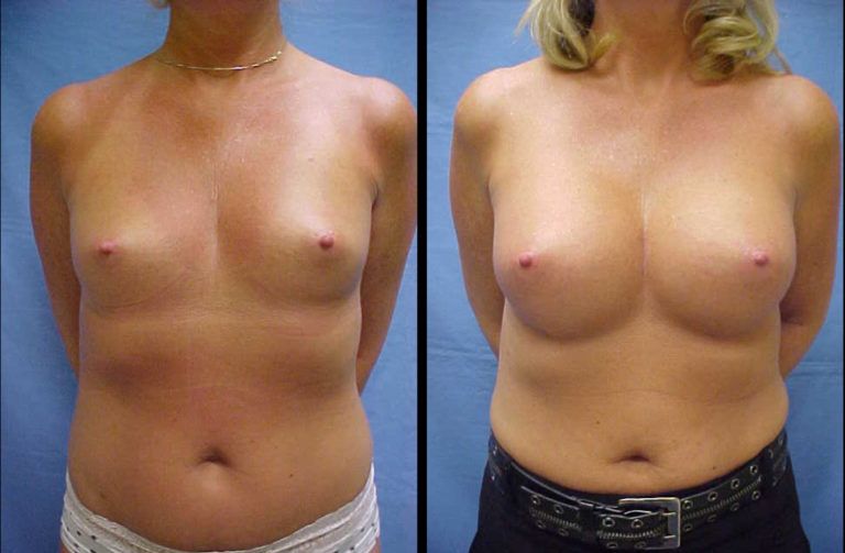 Breast Augmentation Before & After