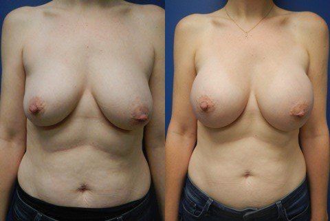 Breast Augmentation Before & After