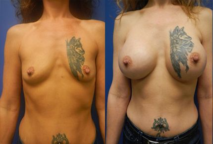 Breast Augmentation Before & After