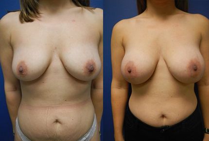 Breast Augmentation Before & After