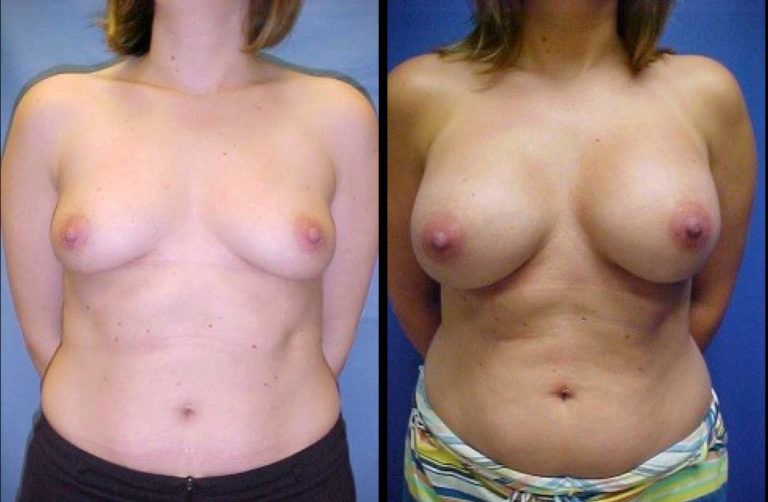 Breast Augmentation Before & After