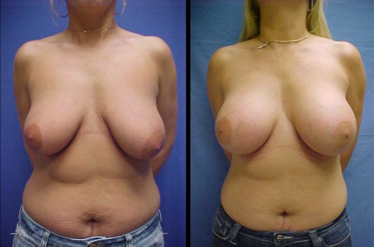 Breast Augmentation Before & After