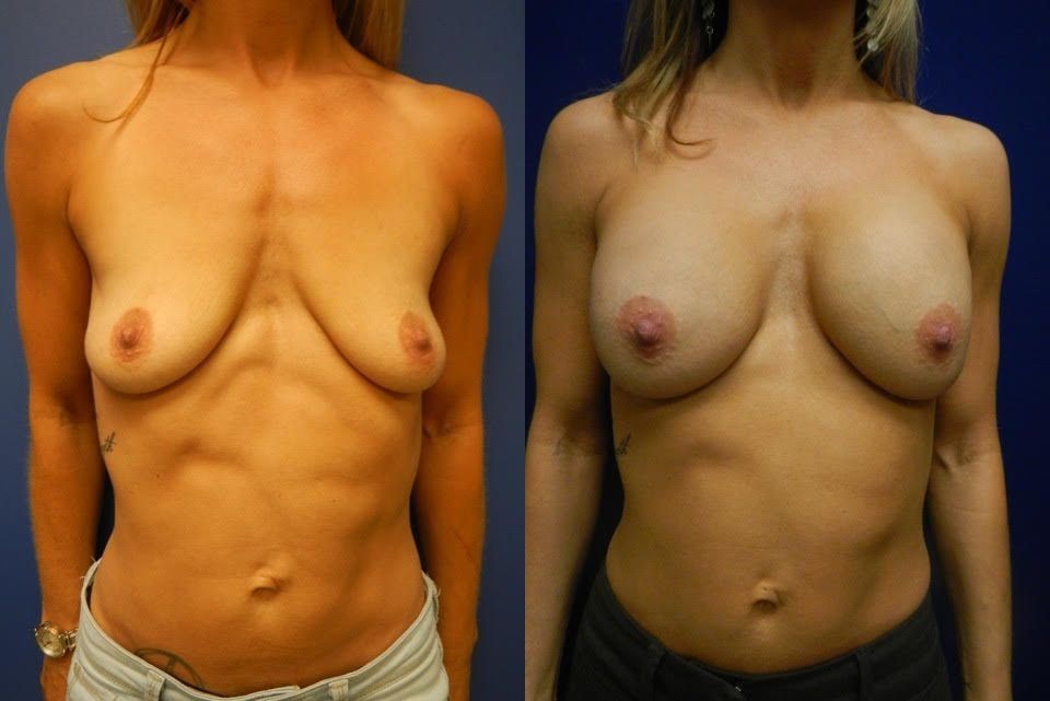 Breast Augmentation Before & After
