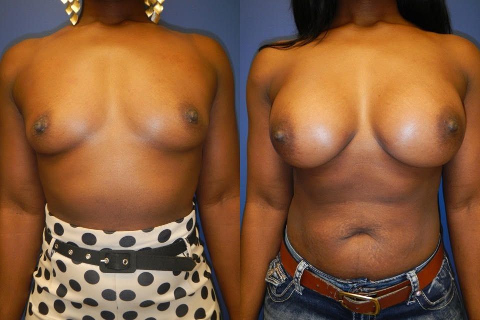 Breast Augmentation Before & After