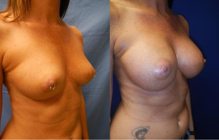 Breast Augmentation Before & After