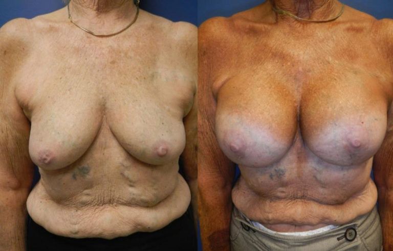 Breast Augmentation Before & After