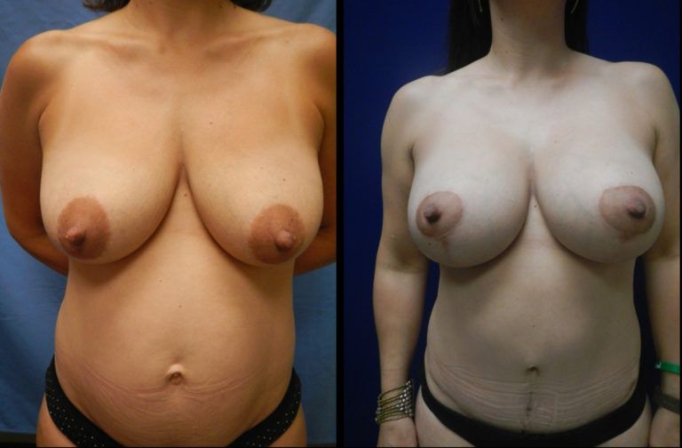 Mommy Makeover Before & After