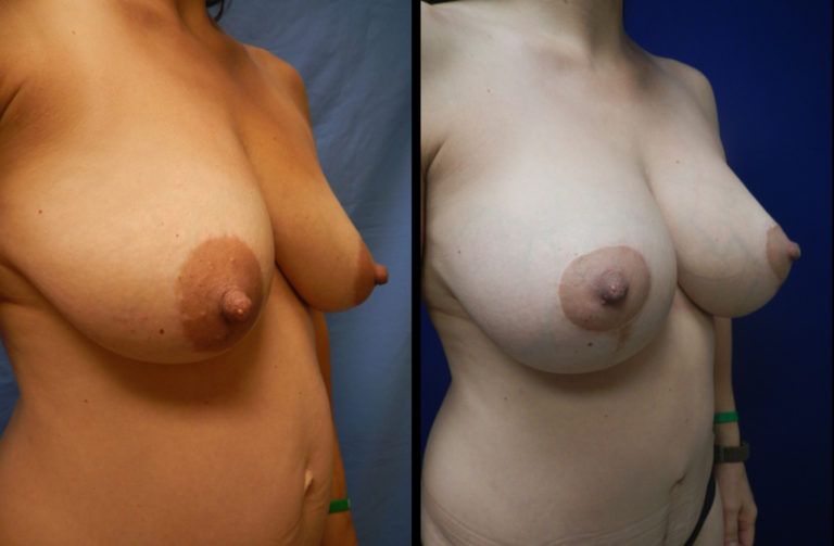 Mommy Makeover Before & After