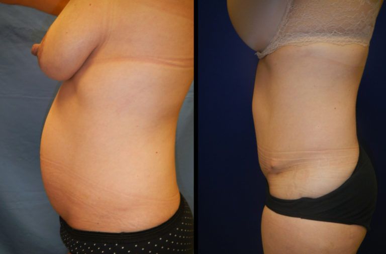 Mommy Makeover Before & After