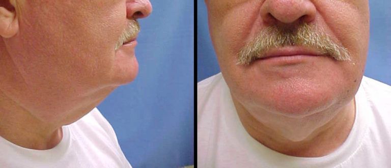 Chin and Neck Contouring Before & After