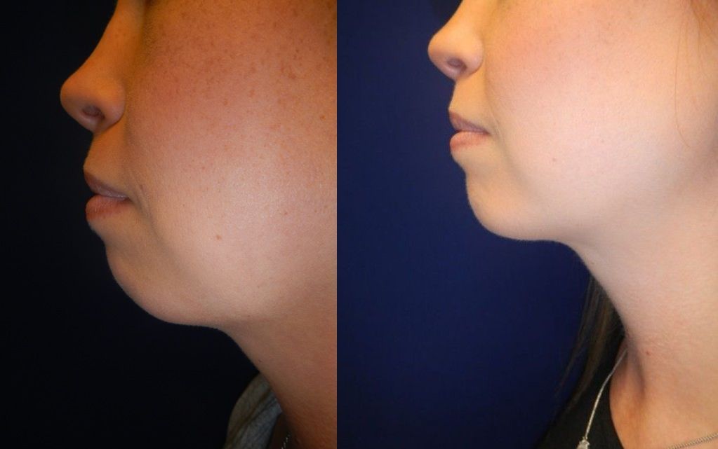 Chin and Neck Contouring Before & After