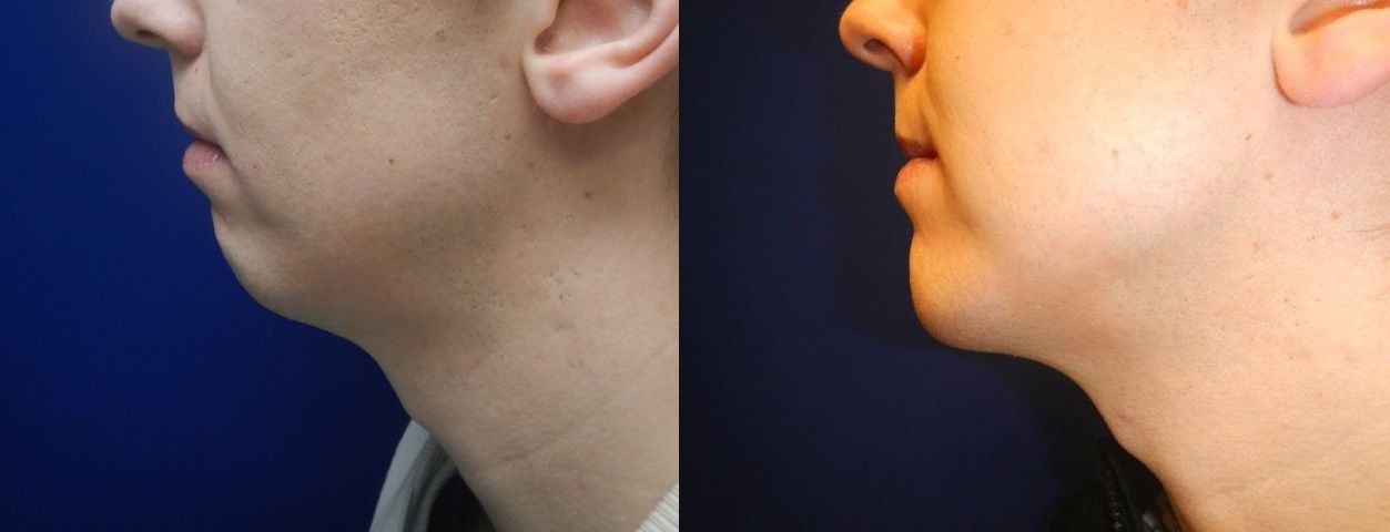 Chin and Neck Contouring Before & After