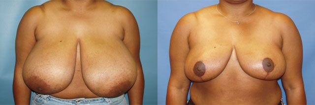 Breast Reduction Before & After