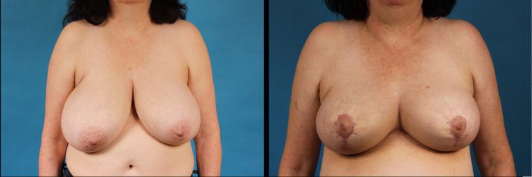 Breast Reduction Before & After