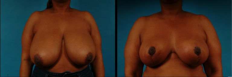 Breast Reduction Before & After