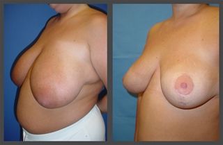 Breast Reduction Before & After