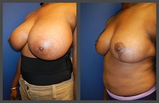 Breast Reduction Before & After