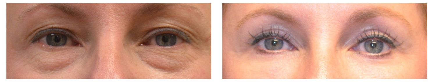 Eyelid Surgery Before & After