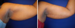 Arm Lift Gallery Before & After