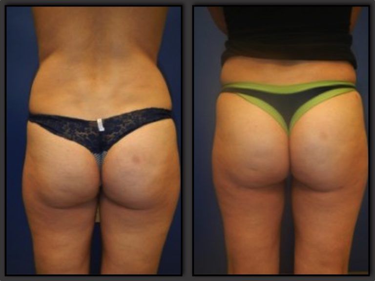 Brazilian Butt Lift Gallery Before & After