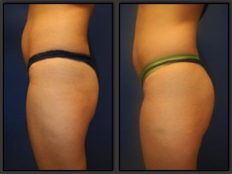 Brazilian Butt Lift Gallery Before & After