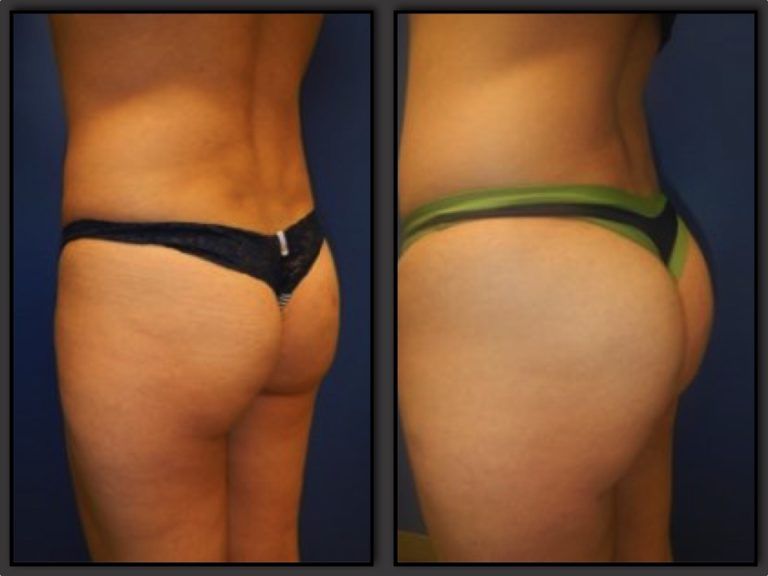 Brazilian Butt Lift Gallery Before & After