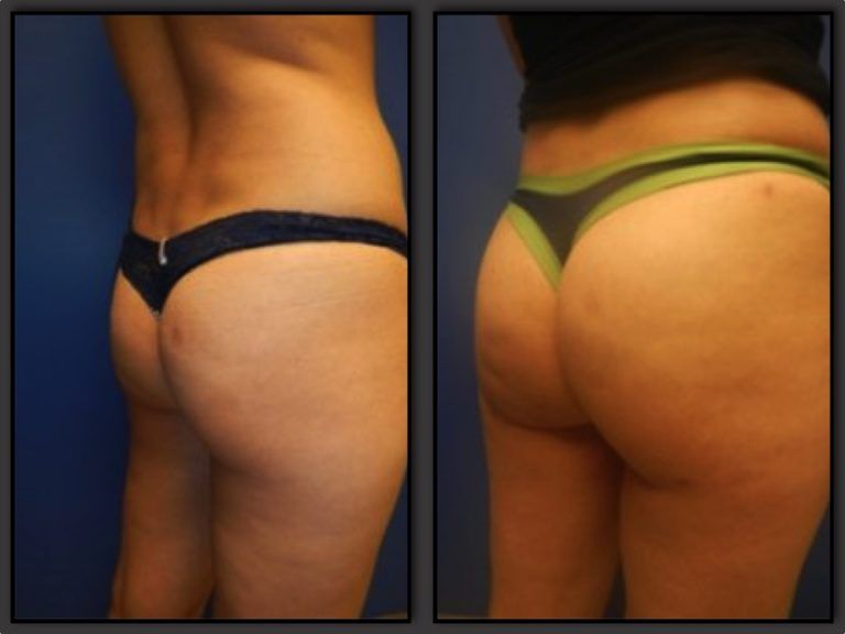 Brazilian Butt Lift Gallery Before & After