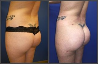 Brazilian Butt Lift Gallery Before & After