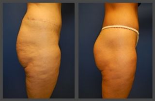Brazilian Butt Lift Gallery Before & After
