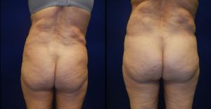 Brazilian Butt Lift Gallery Before & After