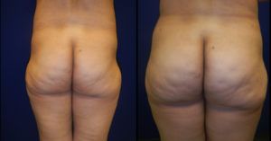 Brazilian Butt Lift Gallery Before & After