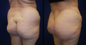 Brazilian Butt Lift Gallery Before & After