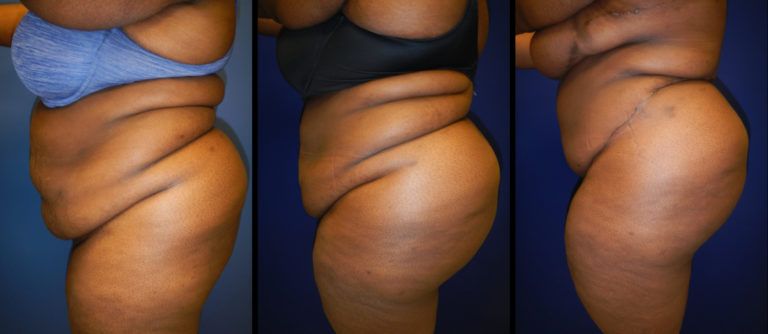 Brazilian Butt Lift Gallery Before & After