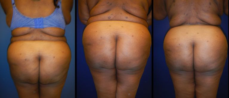 Brazilian Butt Lift Gallery Before & After
