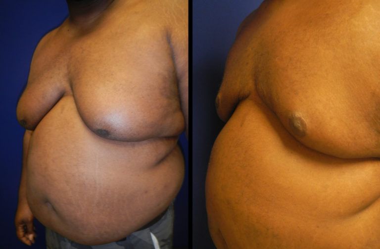 Male Breast Reduction Before & After